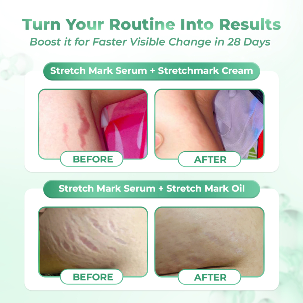 Stretch Mark Serum Booster - Image 6