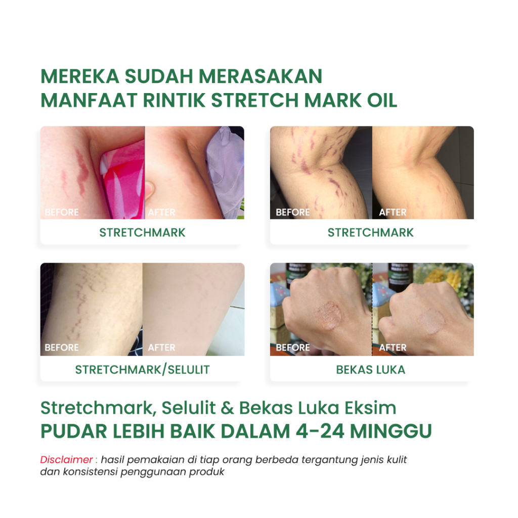 Stretchmark Series - Stretch Mark Oil 1Pcs + Stretch Mark Cream 1Pcs - Image 8