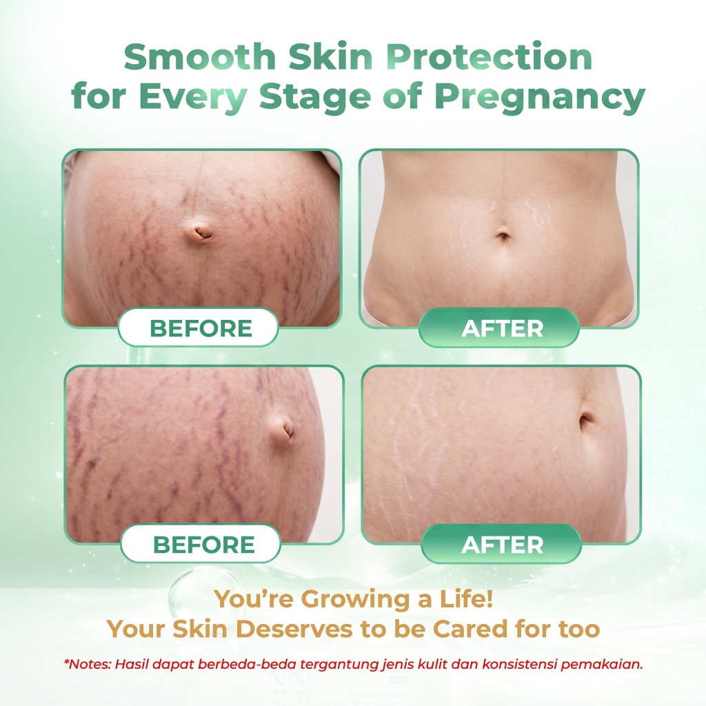 Bundling Stretch Mark Serum 30ml 1 Pcs + Stretchmark Cream 200ml 1 Pcs - Image 6