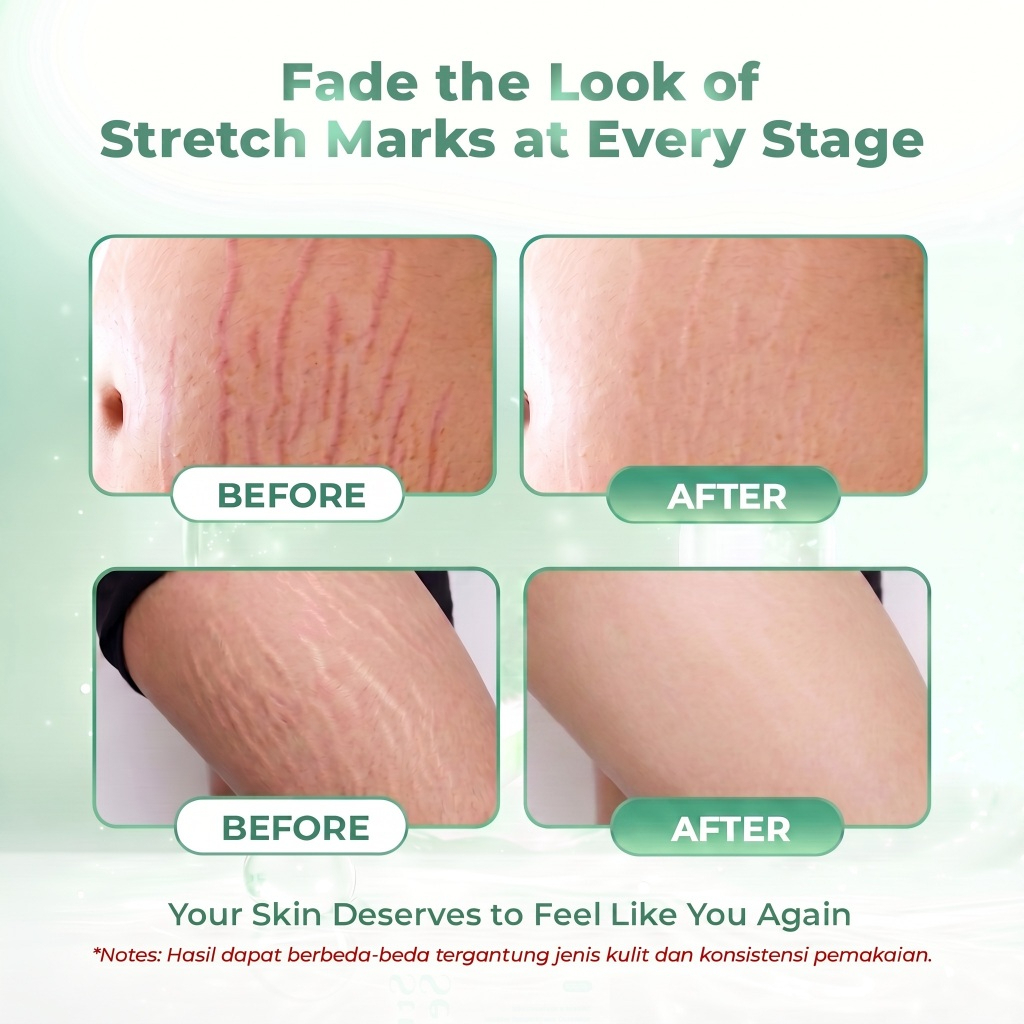 Bundling Stretch Mark Serum 1Pcs + Stretch Mark Oil 1Pcs - Image 6