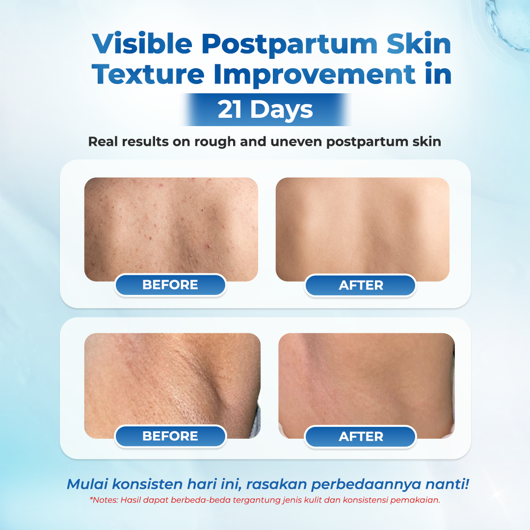 Rintik No Bump Lotion — Body Exfoliating Lotion untuk Kulit Tubuh Kasar, Bruntusan, Chicken Skin & Back Acne Setelah Melahirkan - Image 3
