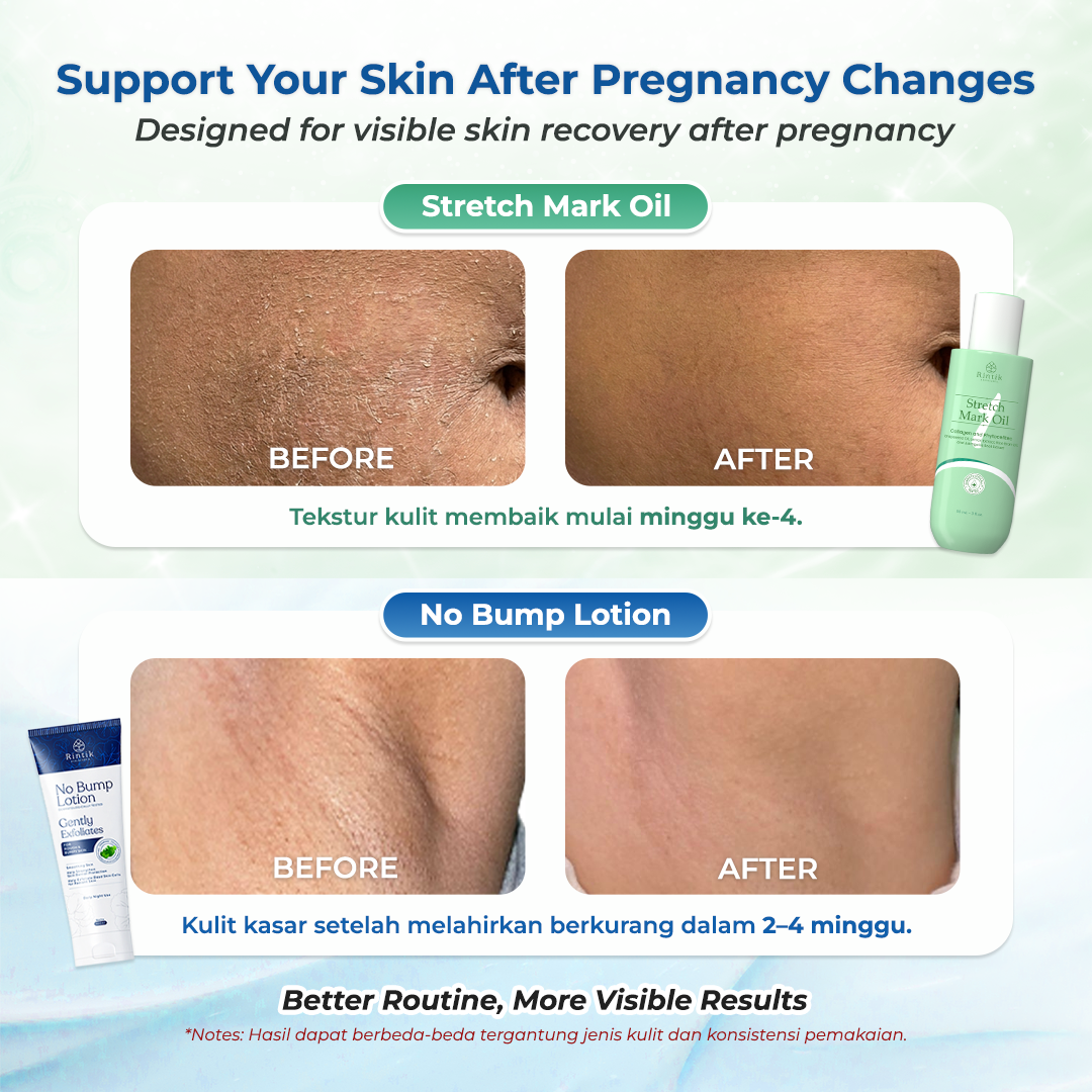 Rintik - Bundle Stretch Mark Cream + Stretch Mark Oil | HALAL BPOM | Penghilang Stretchmark Paling Ampuh (1 pcs Stretch Mark Oil 90 ml + 1pcs Stretchmark Cream 200 ml) - Image 3